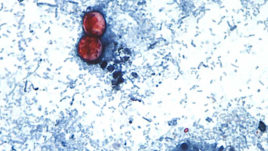 Cyclospora outbreak hits Florida with 60 cases | County-by-county breakdown