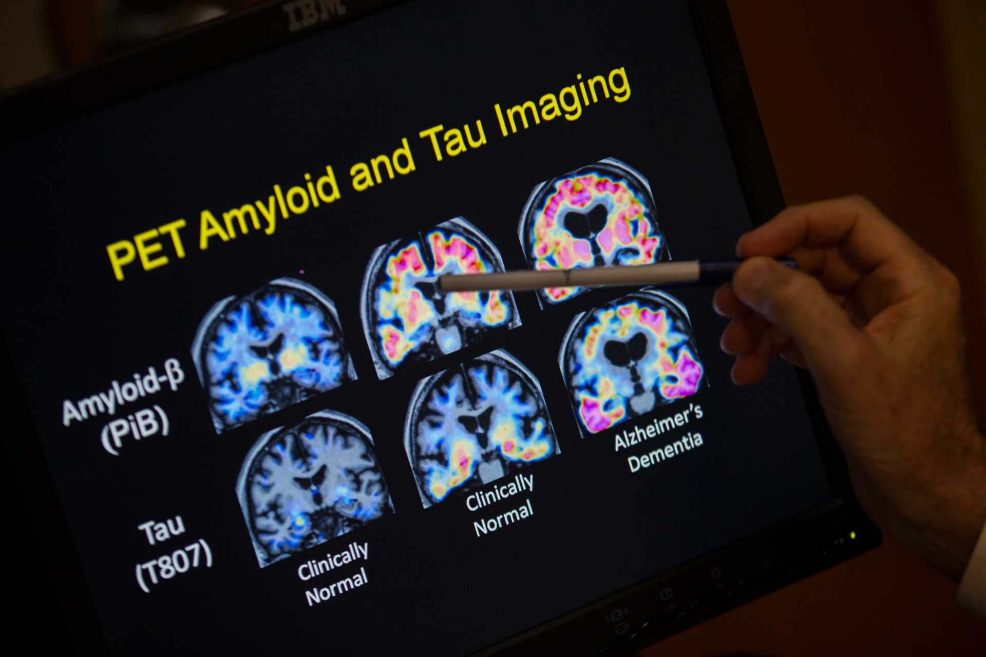 Want to lower your risk of dementia? It doesn't involve a blood test
