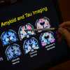 Want to lower your risk of dementia? It doesn't involve a blood test