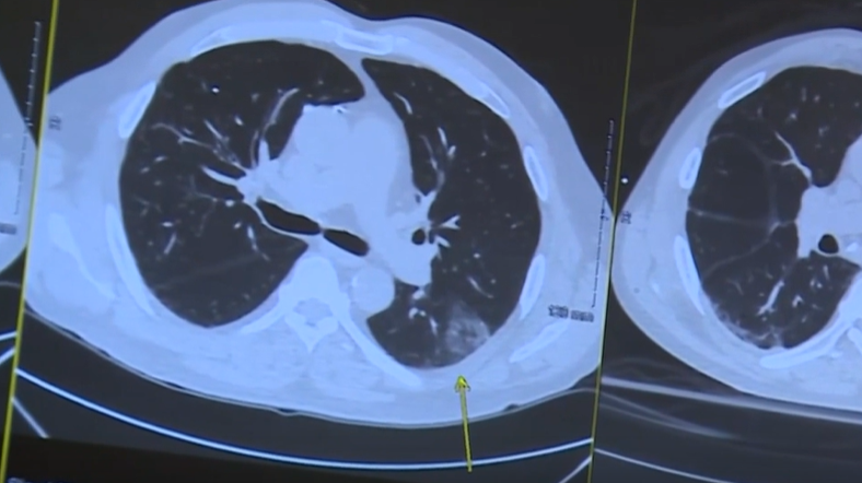 Woman celebrates being cancer-free after early lung cancer diagnosis