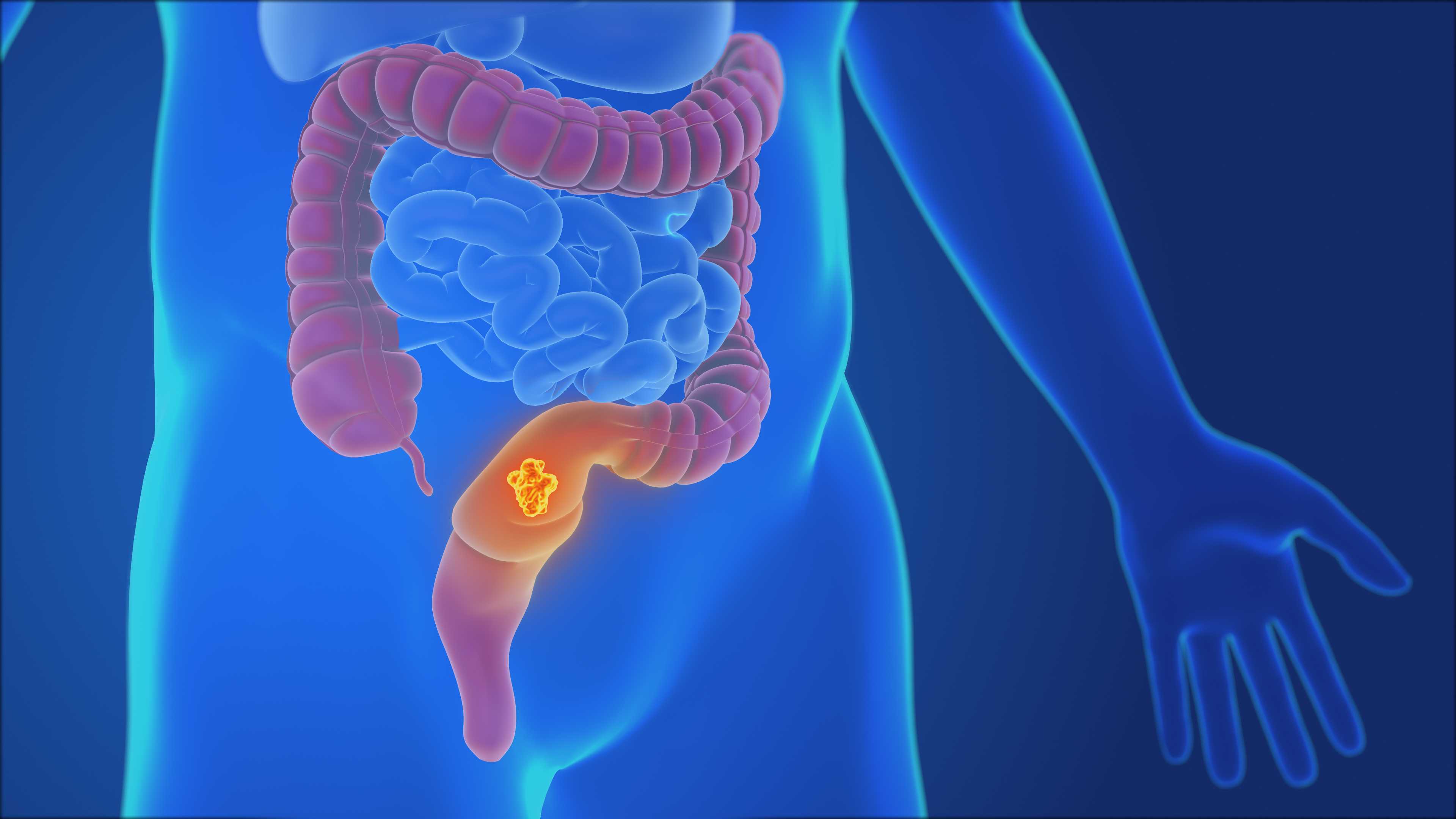 Younger patients diagnosed with colorectal cancer