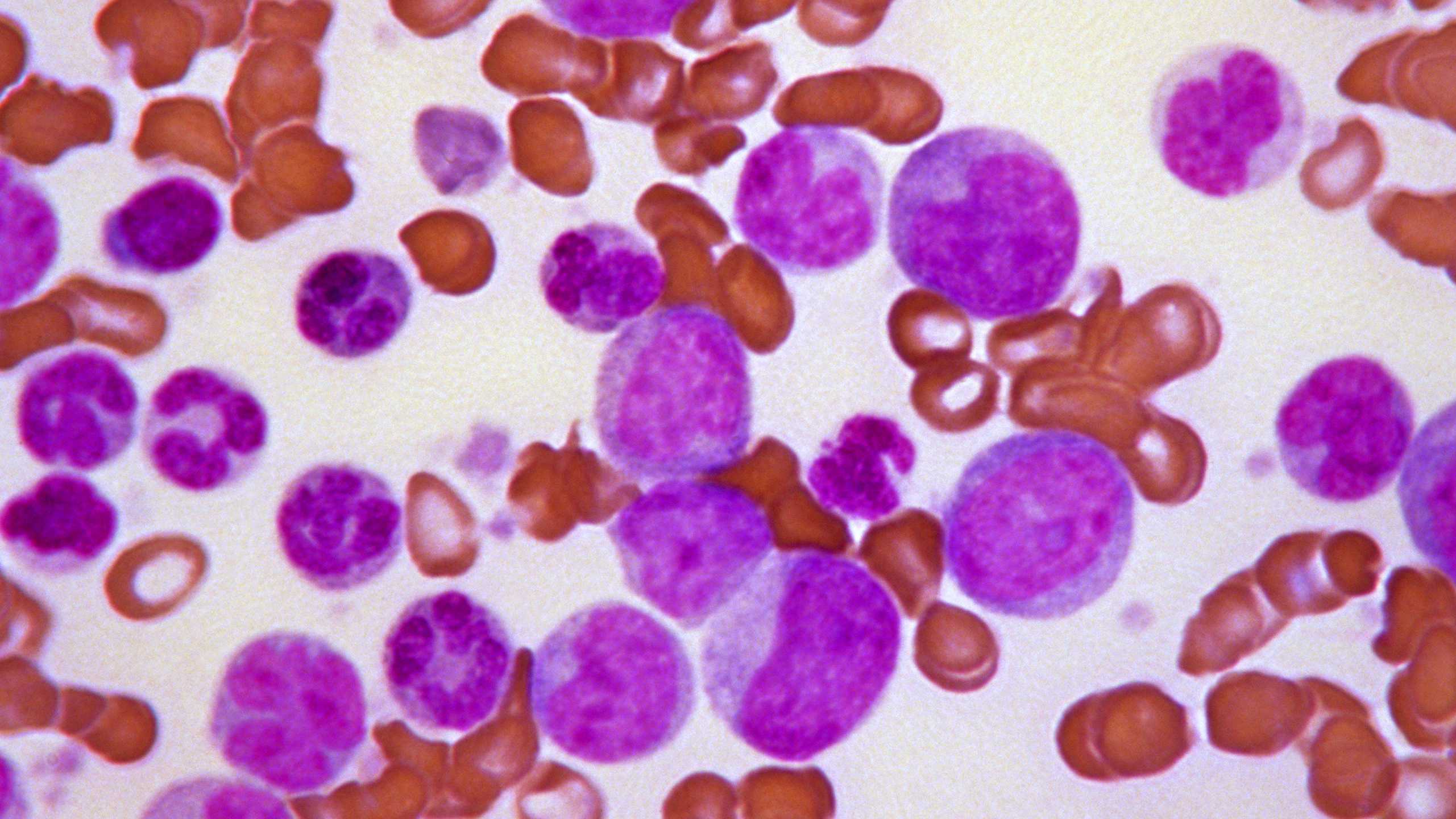 Blood Cancer United effort grows in Mississippi with help for patients