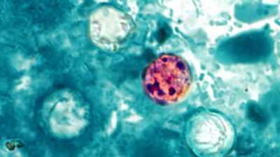What we know about past outbreaks linked to parasite that can lead to ‘explosive diarrhea’ ketv
