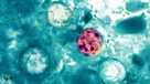 cyclosporiasis
