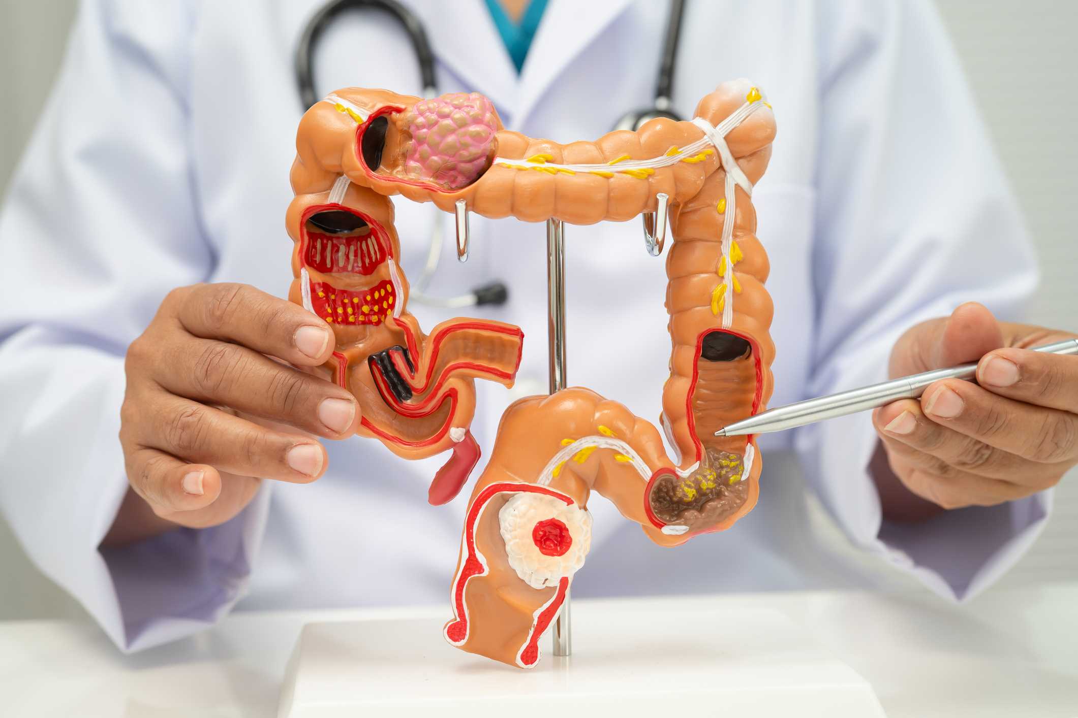 Colorectal cancer risk rises for adults under 50 in Florida - WBBH