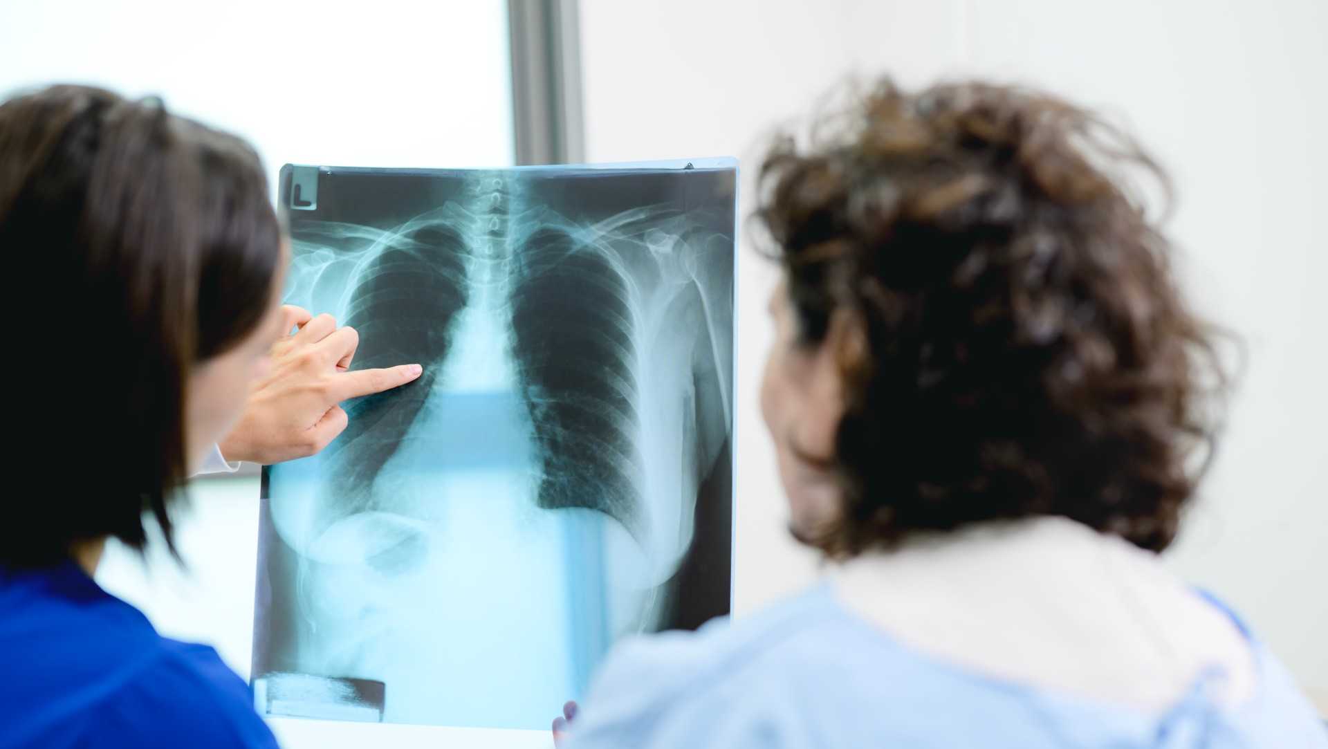 AI tool predicts lung cancer risk years in advance