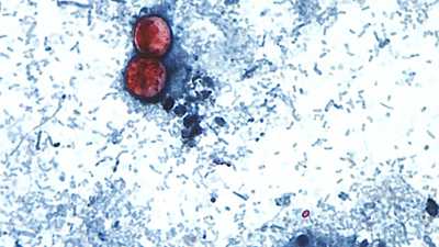 What is cyclosporiasis and how can you avoid catching the GI illness?wdsu