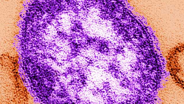 Health officials: Measles virus detected in Douglas County wastewater, no confirmed cases