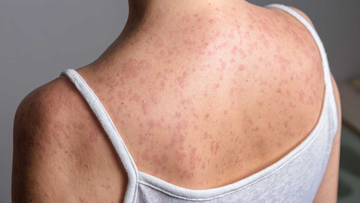 Iowa officials identify places visited during measles contagion - KCCI