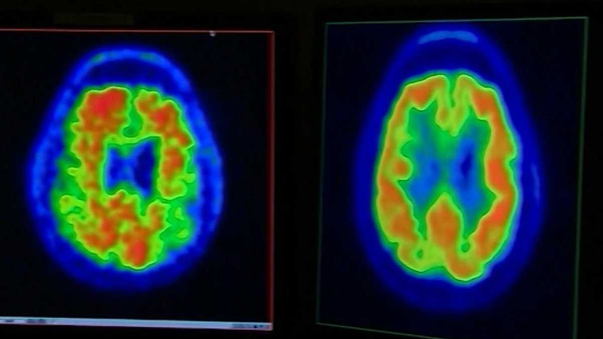 Woman's Doctor: Women over 50 should never ignore these Alzheimer's signs