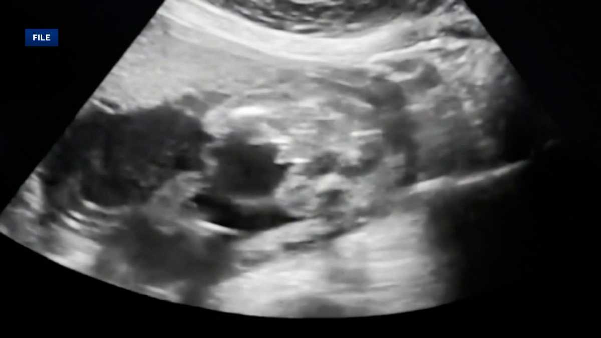 Abortion bill that would increase penalties for doctors and mothers in South Carolina advances