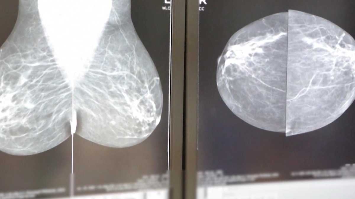 Trial uses medication over chemo, radiation for breast cancer