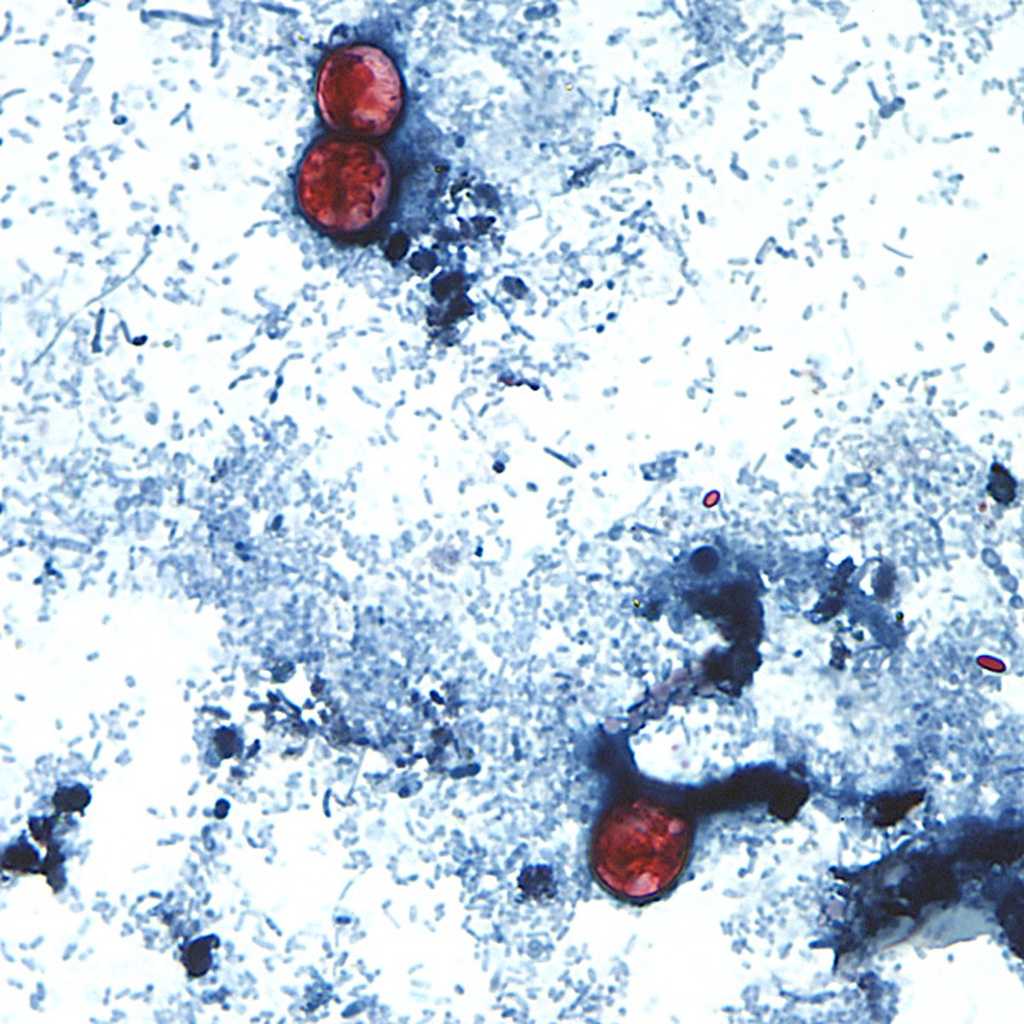 Maryland health officials report 69 cases of cyclosporiasis this year; cases have more than doubled since last week