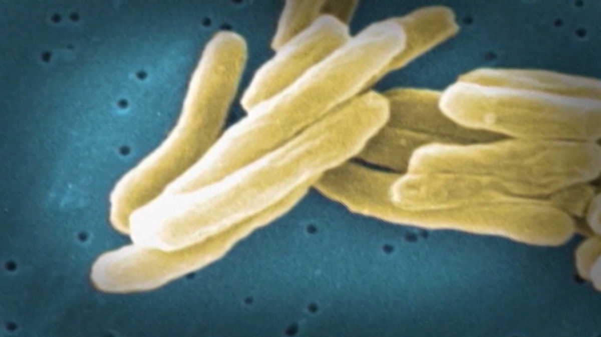 Two tuberculosis diagnoses in the Enid Public Schools student body are raising concern, but doctors say the illness is treatable.