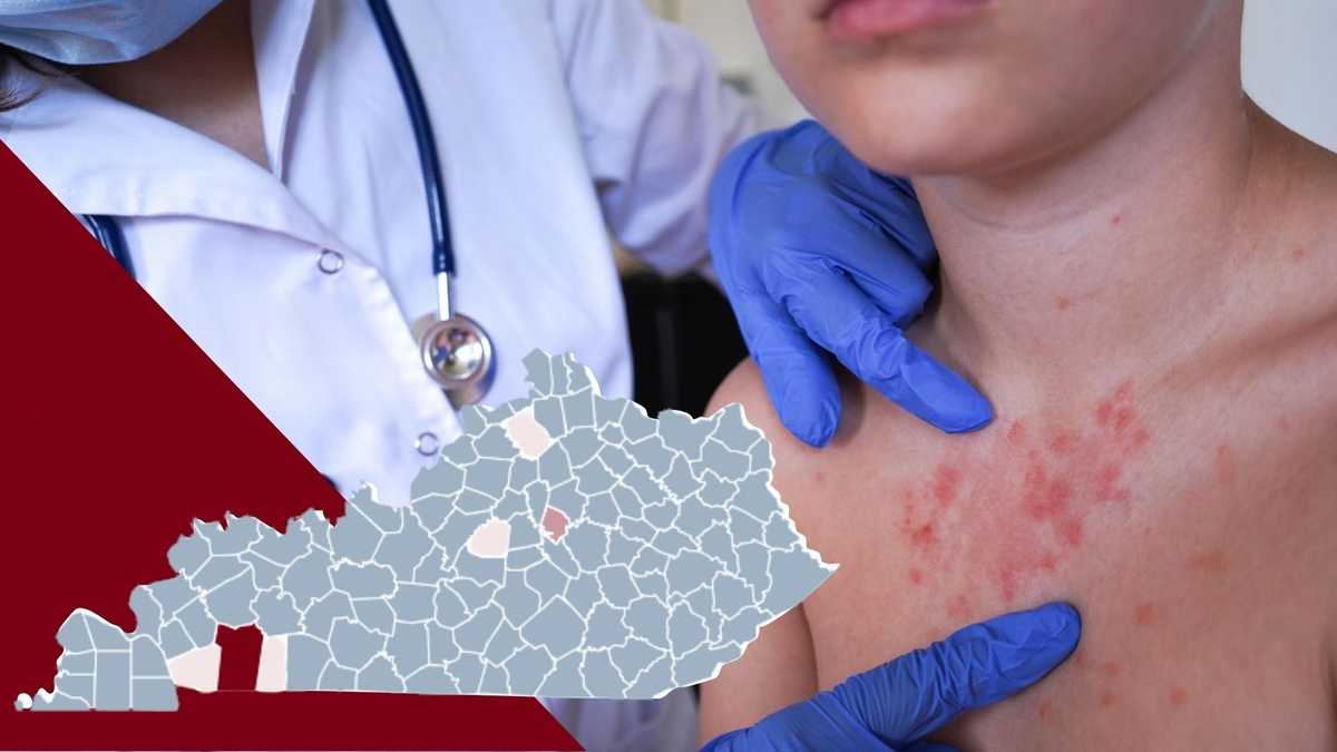 Health officials urge vaccination as measles cases hit 35-year high in Kentucky
