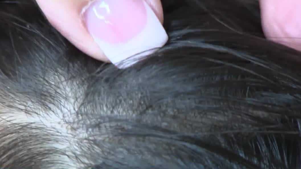 Consumer Reports notes back-to-school season highlights concerns over head lice treatments