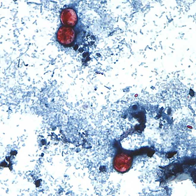 This photomicrograph of a fresh stool sample reveals the presence of three uniformly stained Cyclospora cayetanensis oocysts in the field of view