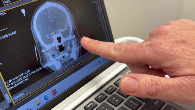 New stroke guidelines save Southwest Florida man after major overnight stroke