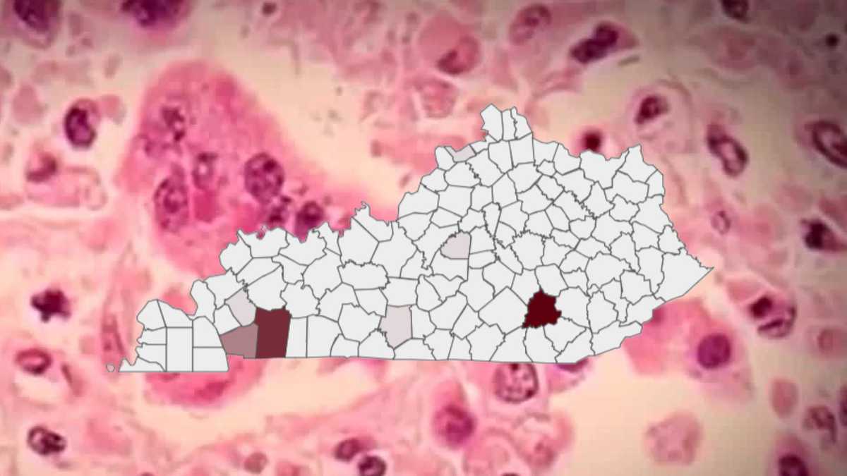 Measles Cases Surge Past 150 in Kentucky; Major Outbreak Identified in Laurel County