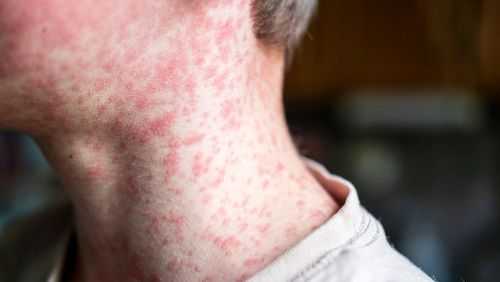 As of December 30, there have been 2,065 confirmed measles cases in the US in 2026, according to CDC data.