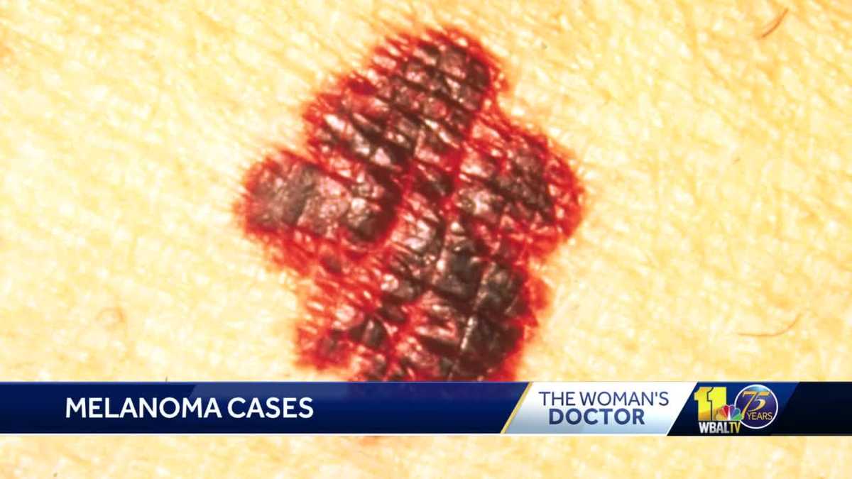 the-woman-s-doctor-melanoma-the-most-common-skin-cancer