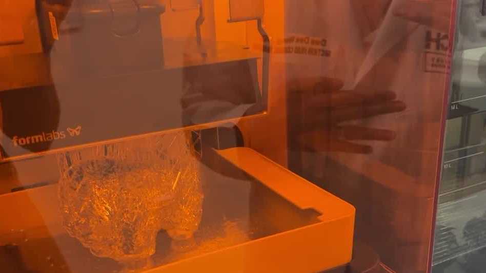 NCH doctors use 3D printing to save woman's life after heart attack