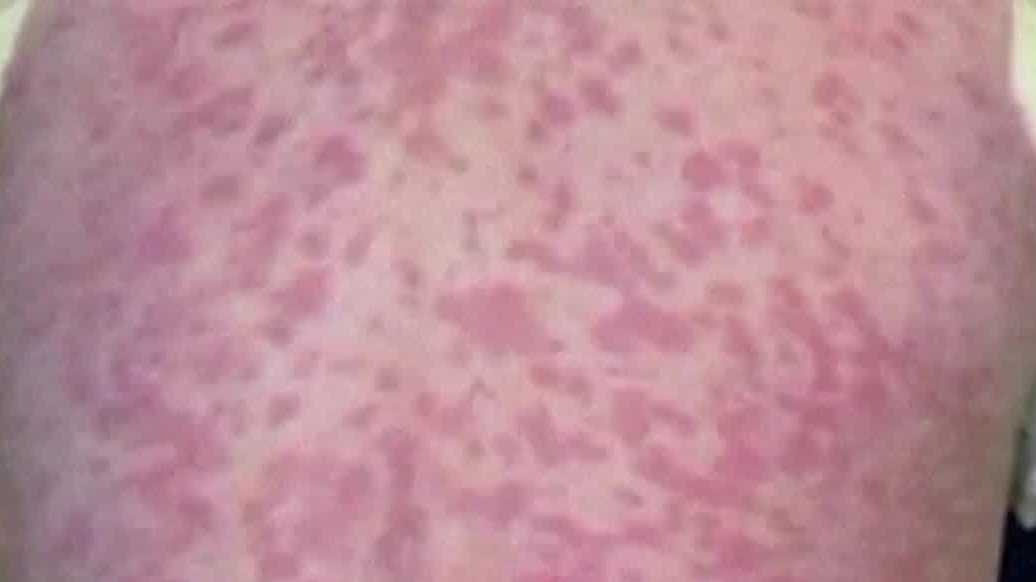 Measles cases linked to Ave Maria University rise to 11; 4 hospitalized