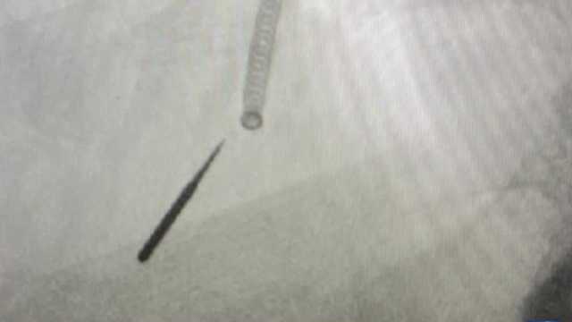 Patient inhales 1-inch dental drill bit - Vimarsana News
