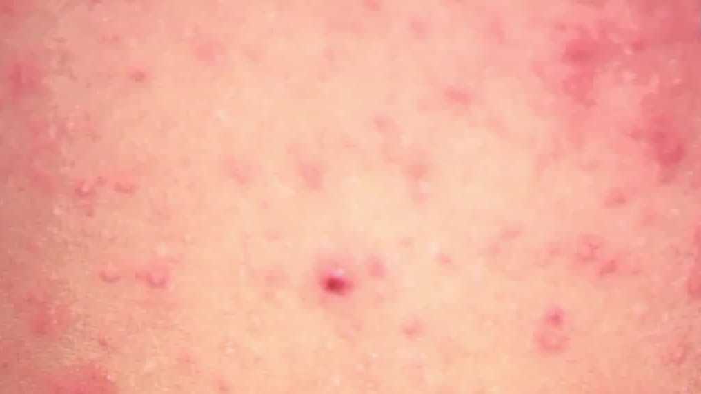 Measles cases stay flat in Florida