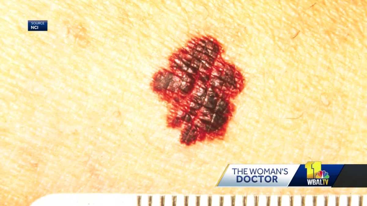 Melanoma can be treatable if caught early | Woman's Doctor