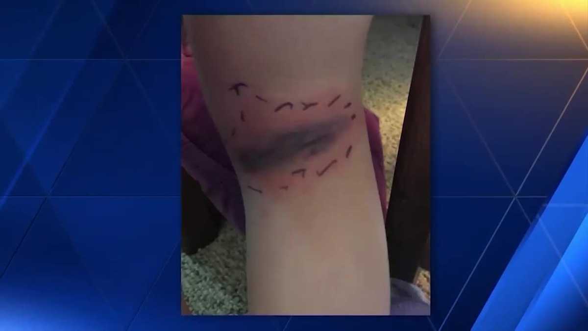 Black widow spider bite sends Massachusetts girl to hospital