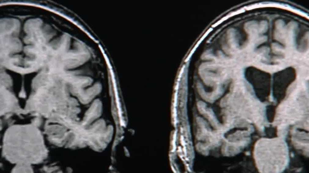 Bruce Willis' diagnosis shines light on dementia care in New Hampshire
