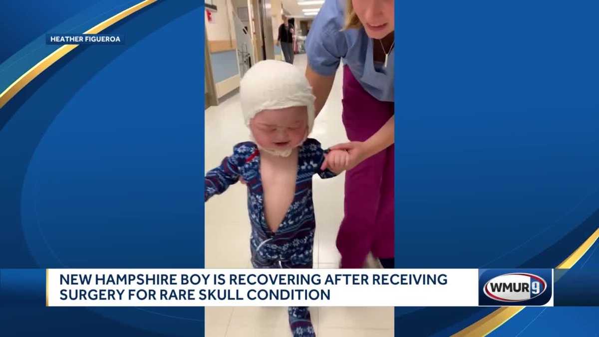 Boy recovering after surgery for rare skull condition