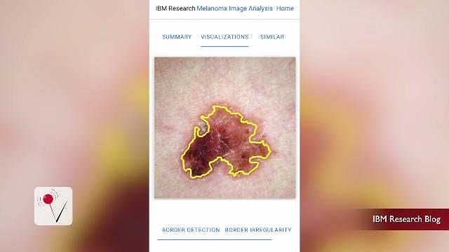 Your Smartphone Camera May Soon Help Detect Skin Cancer - KCCI