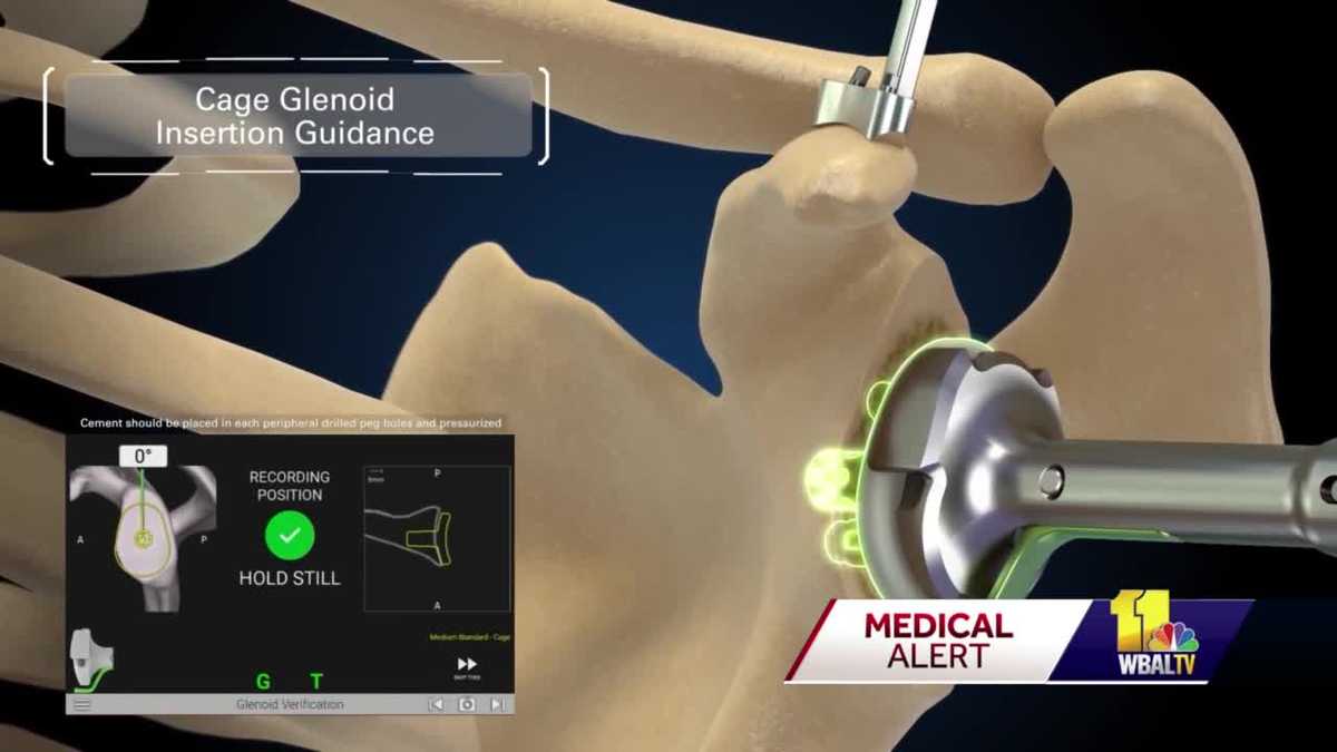 Tech allows quicker recovery from shoulder replacement surgery