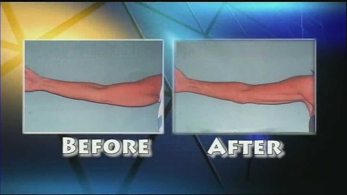 New treatment available for people dealing with loose arm skin