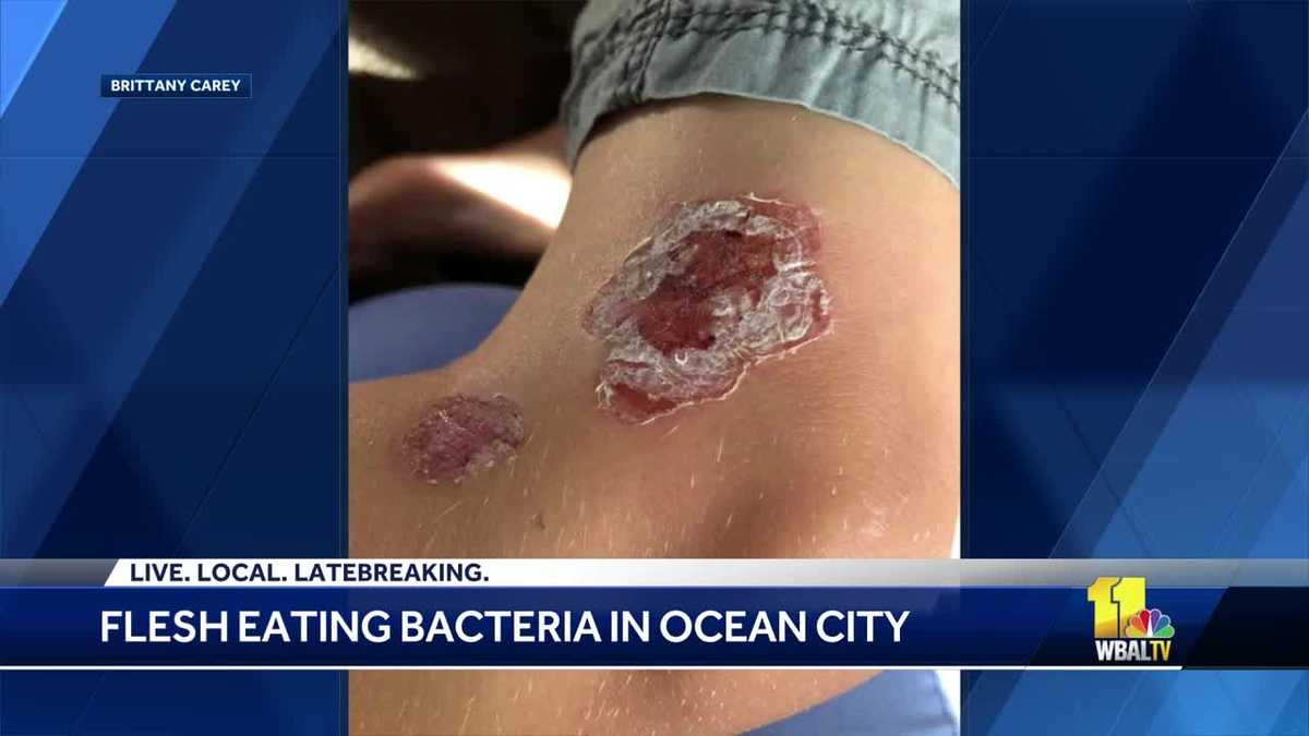 maryland says son infected with flesh eating bacteria flesh eating bacteria pictures
