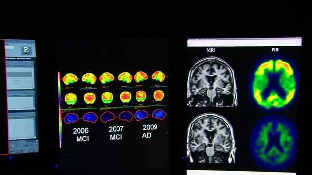 Drug shows promise in reducing Alzheimer's brain decline - Vimarsana News