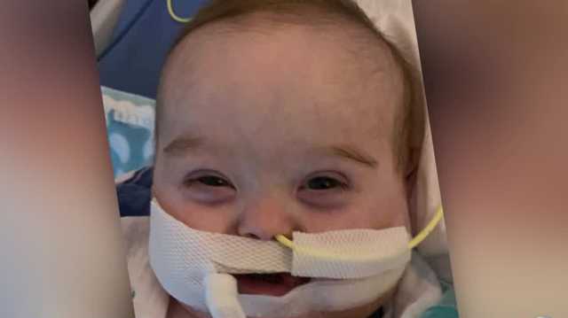 Baby with Down syndrome in pediatric ICU bed with COVID-19 - Vimarsana News