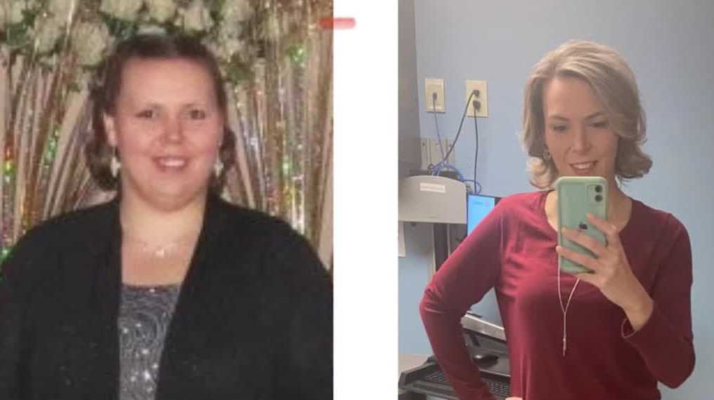 Louisville woman says lap band surgery changed her life for the better