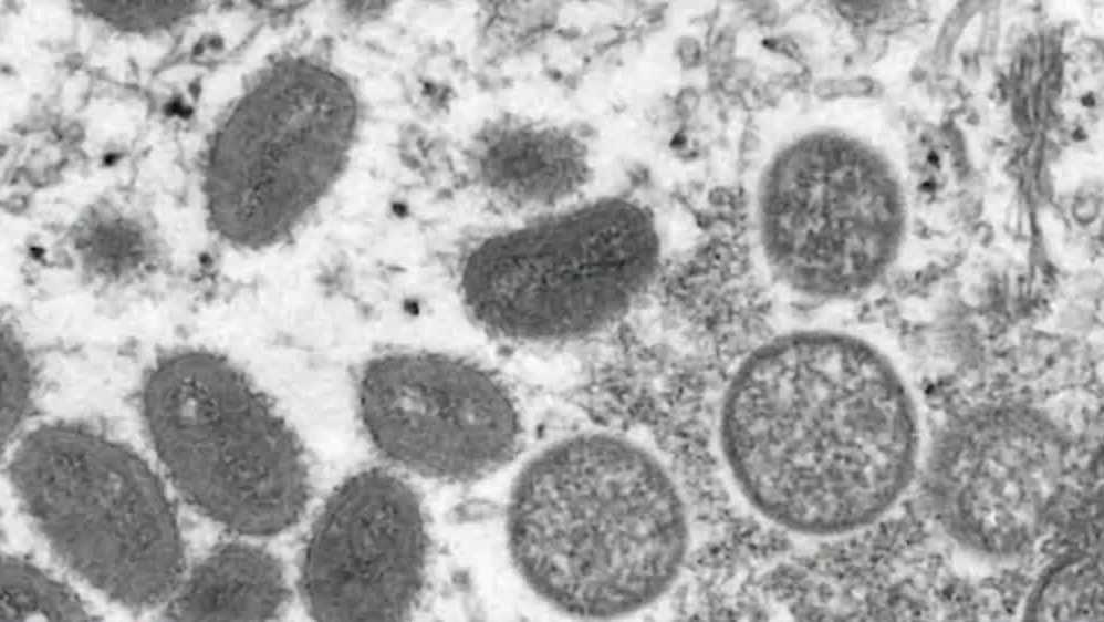 Locais de vacina contra Monkeypox: 11 locais abertos em Massachusetts