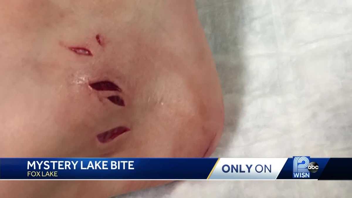 Boy receives 16 stitches after being bitten by fish in lake