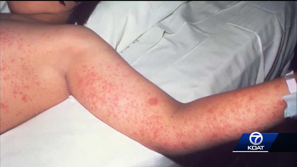 Potential measles exposure in Bernalillo, Sandoval and Santa Fe counties - KOAT