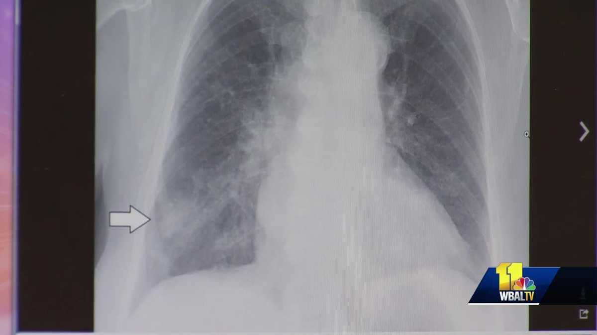 What Happens If Walking Pneumonia Is Left Untreated