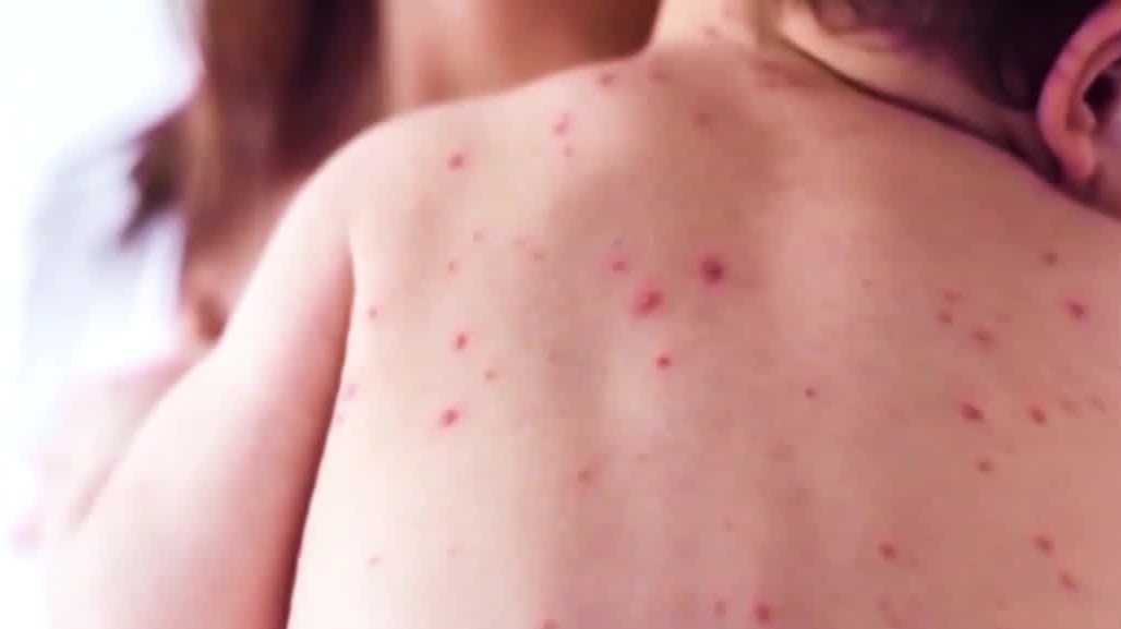 3 children in WNC test positive for measles after visit to Spartanburg County