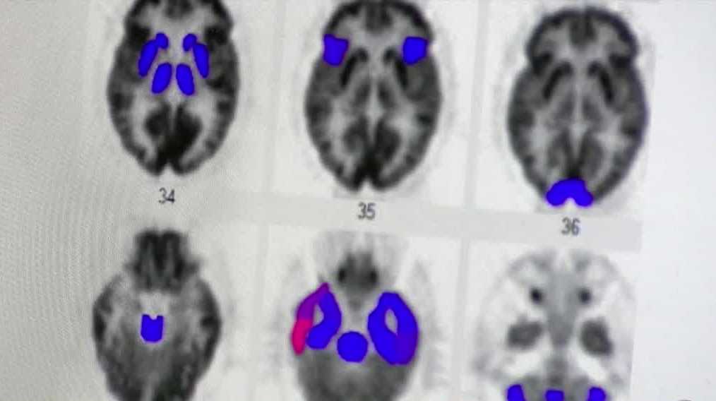 Concussion research and prevention in youth sports