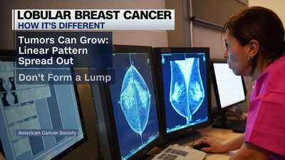 What to know about the lesser-known breast cancer type on the rise