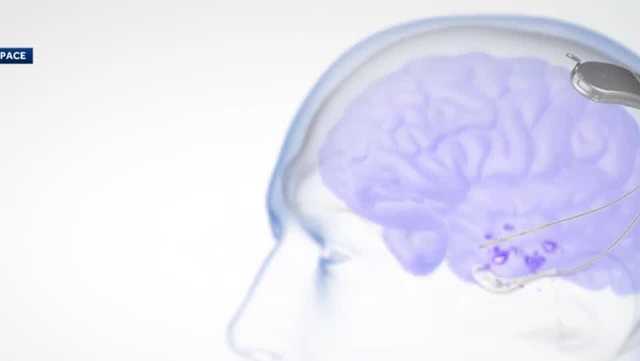 Implant helps woman control epileptic seizures - Vimarsana News