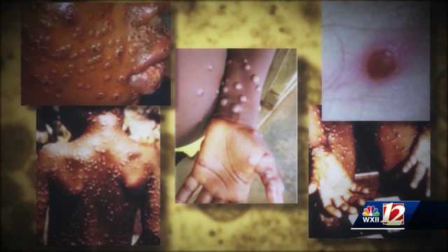 Health experts explain monkeypox concerns after first case confirmed in Piedmont Triad - Vimarsana News