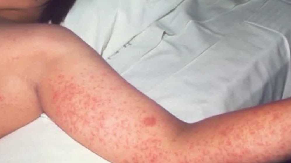 Pittsburgh doctor warns parents as measles cases rise in Pennsylvania